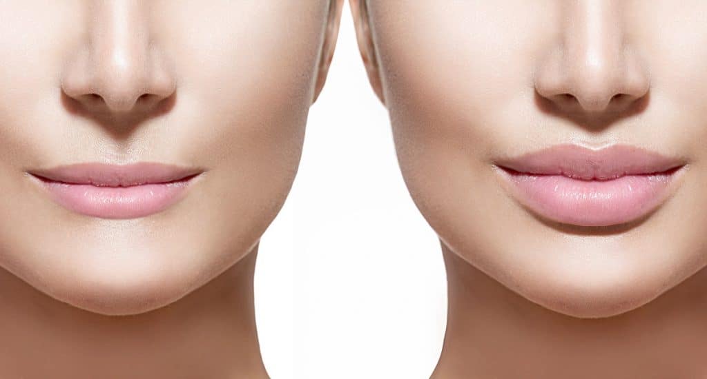 Preechimento Labial